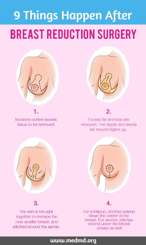 Breast Reduction Surgery Infographic