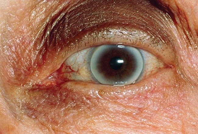 Corneal Lenses - Keratoplasty Eye Surgery