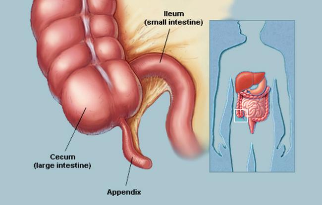 Medication for Appendicitis