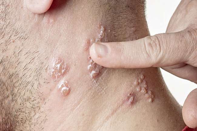 Severe Eczema Itch Relief