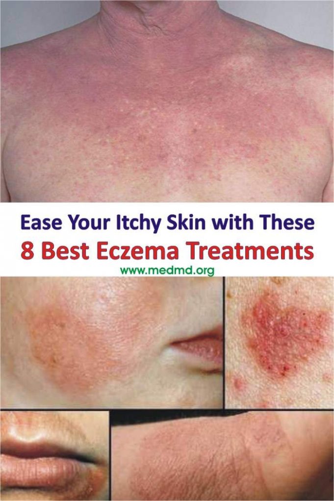 Ease Your Itchy Skin with These 8 Best Eczema Treatments