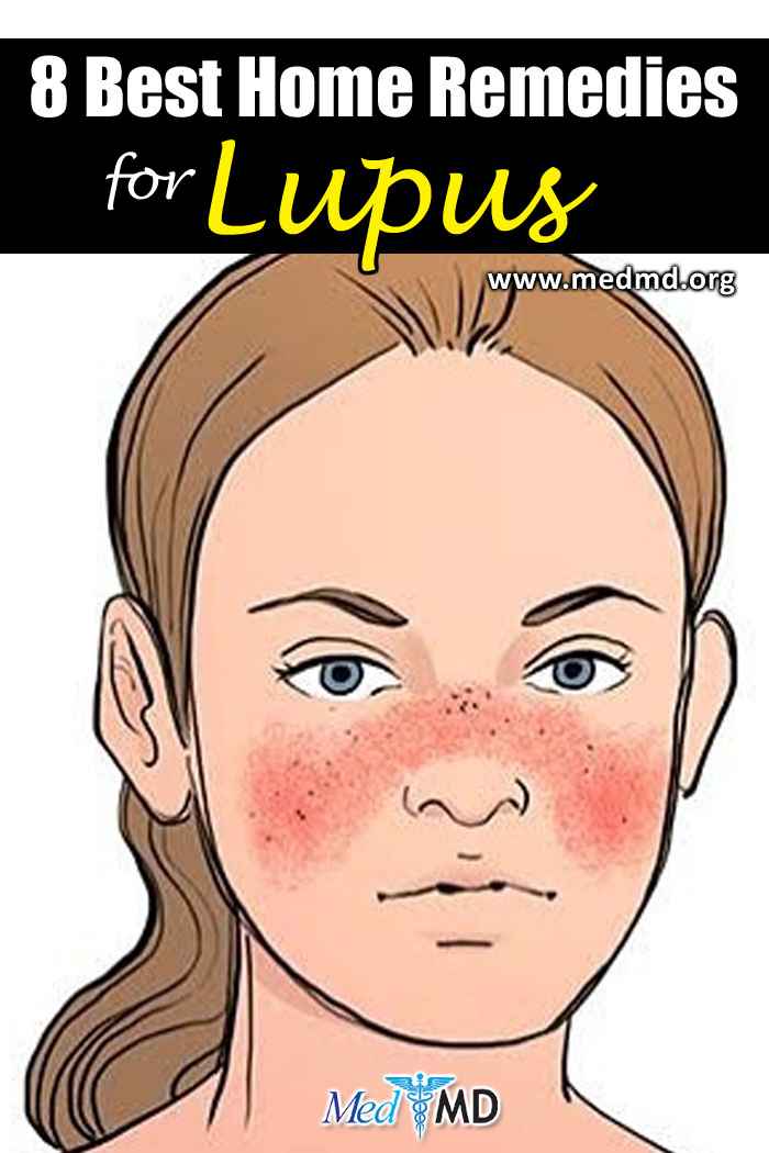 Best Home Remedies for Lupus