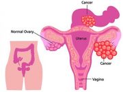 Ovarian Cancer Symptoms and Causes