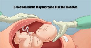 Diabetes and C-Section Birth